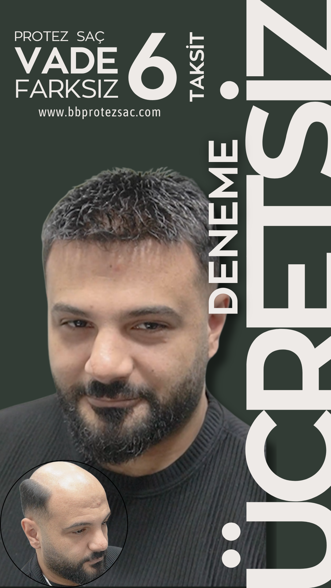 Protez Saç Hakkında Bilinmesi Gerekenler